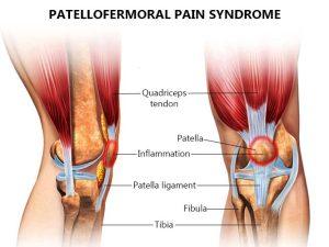 Patellofemoral Pain Syndrome